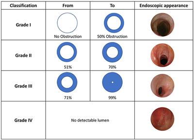 Endoscopic Preoperative Assessment, Classification of Stenosis, Decision-Making